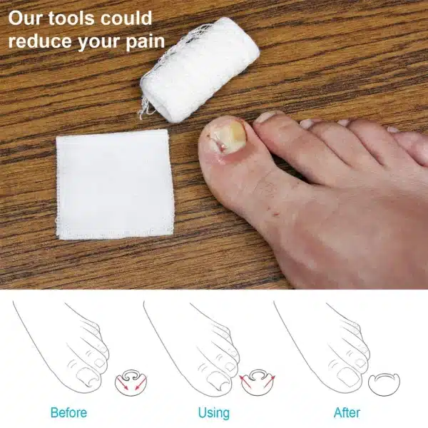 1 Pair Gel Toe Protectors Ingrown Toenail Corrector Toenails Pads Paronychia Correction Tool for Women Men Pain Relief - Image 2