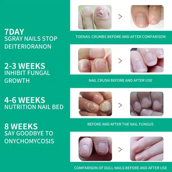 Extra Strong Nail Fungus Treatment Serum Essence Oil Feet Nails Repair Care Essence Cream Anti Infection Toe Fungal Removal Gel - Image 2