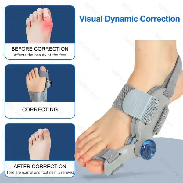 Adjustable Hallux Valgus Big Toe Corrector Orthopedic Bunion Corrector Device Foot Pain Relief Splint Toe Orthopedic Supplies - Image 2