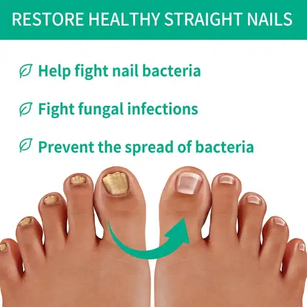 Extra Strong Nail Fungus Treatment Serum Essence Oil Feet Nails Repair Care Essence Cream Anti Infection Toe Fungal Removal Gel - Image 3